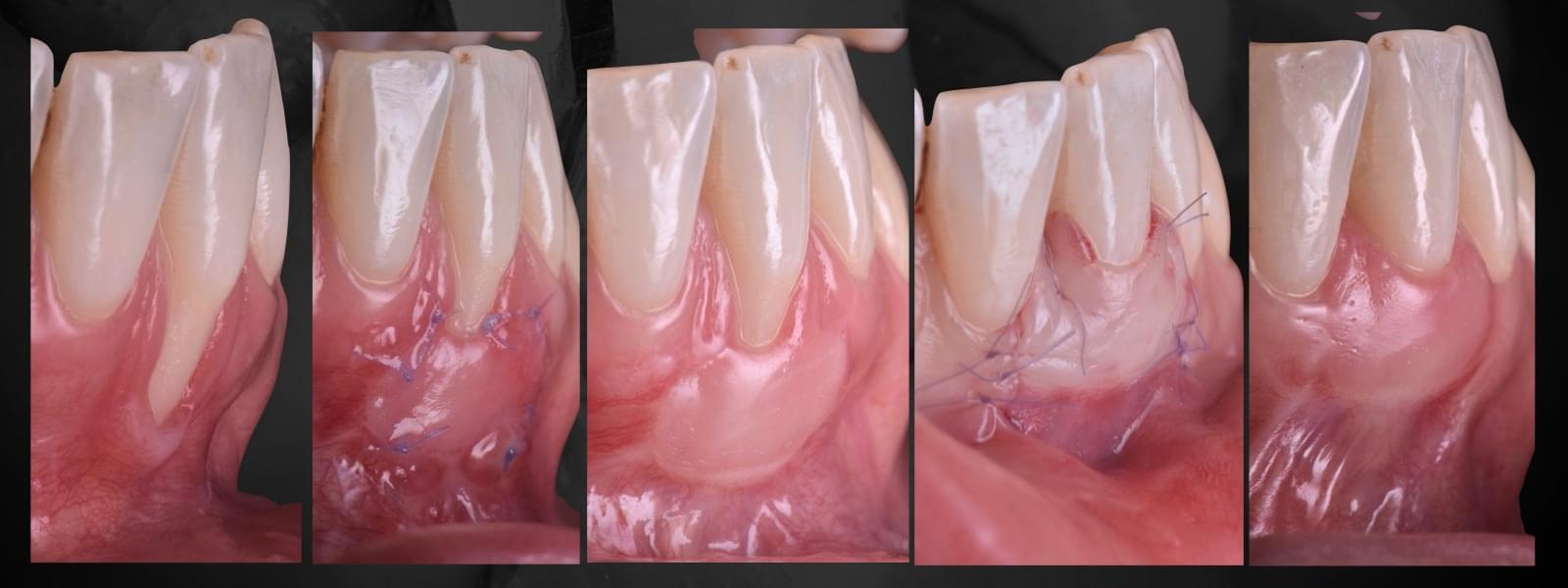 Mucogengivale | Eugenio Longo | FormaDentis