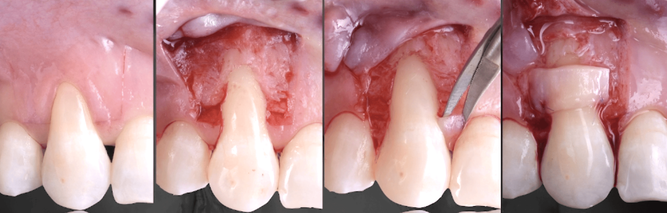 Mucogengivale | Eugenio Longo | FormaDentis